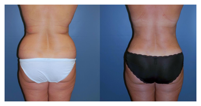 Liposuction of Back and Flanks - Associates in Plastic Surgery