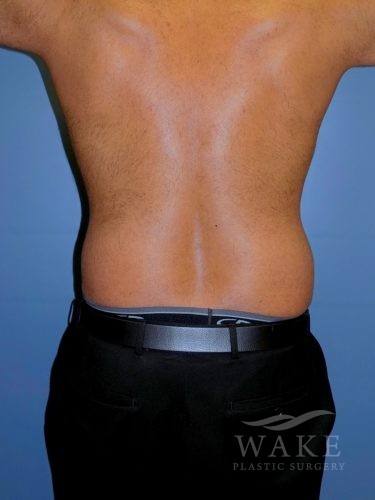 Male Liposuction Gallery